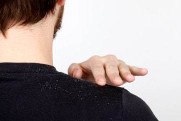dandruff-1